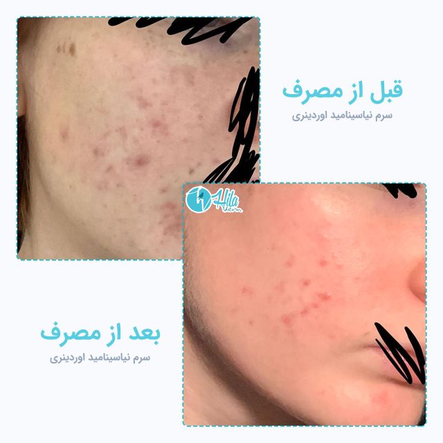 نتیجه قبل و بعد از مصرف سرم نیاسینامید اوردینری