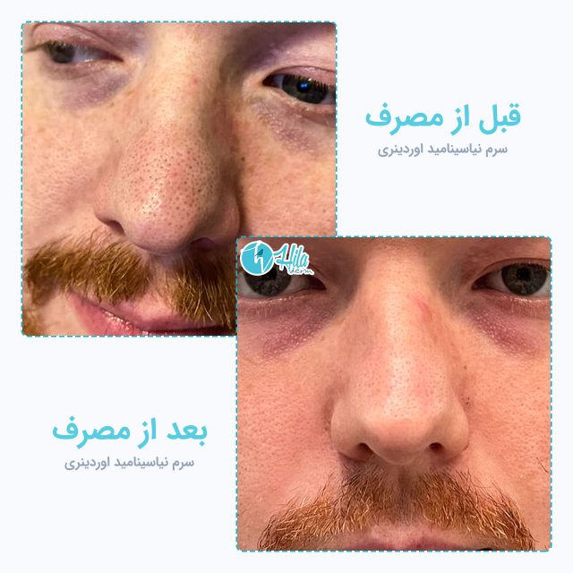 نتیجه قبل و بعد از مصرف سرم نیاسینامید اوردینری