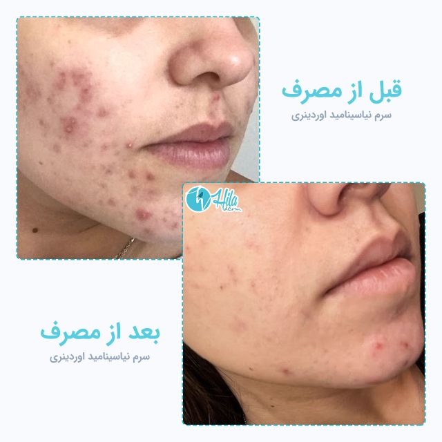نتیجه قبل و بعد از مصرف سرم نیاسینامید اوردینری
