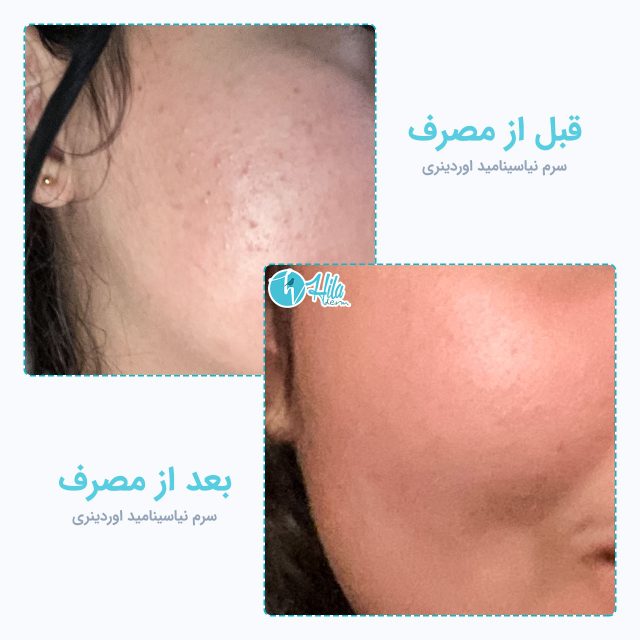نتیجه قبل و بعد از مصرف سرم نیاسینامید اوردینری
