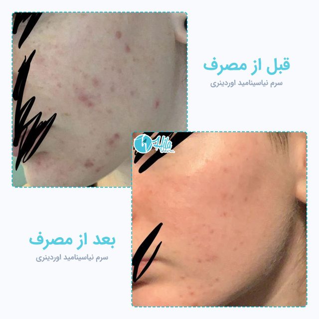 نتیجه قبل و بعد از مصرف سرم نیاسینامید اوردینری