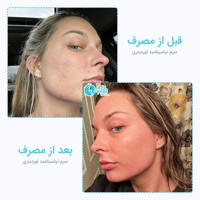 نتیجه قبل و بعد از مصرف سرم نیاسینامید اوردینری