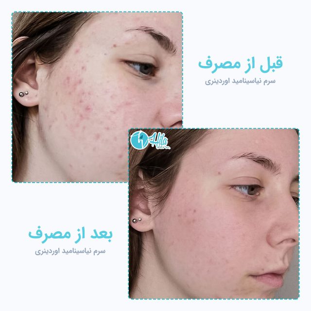 نتیجه قبل و بعد از مصرف سرم نیاسینامید اوردینری