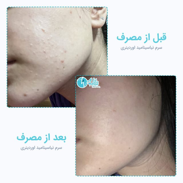 نتیجه قبل و بعد از مصرف سرم نیاسینامید اوردینری
