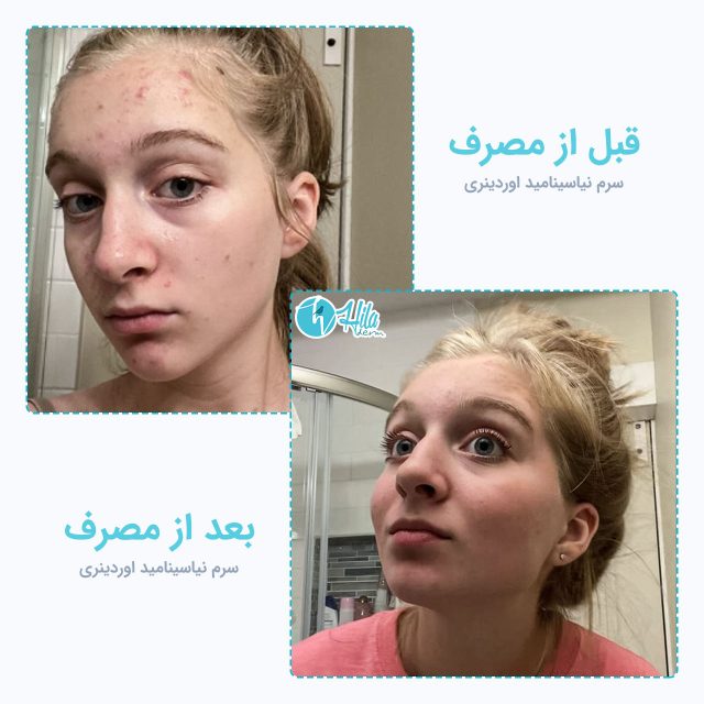نتیجه قبل و بعد از مصرف سرم نیاسینامید اوردینری