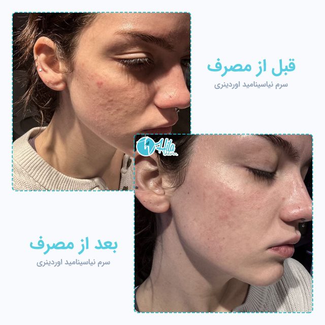نتیجه قبل و بعد از مصرف سرم نیاسینامید اوردینری